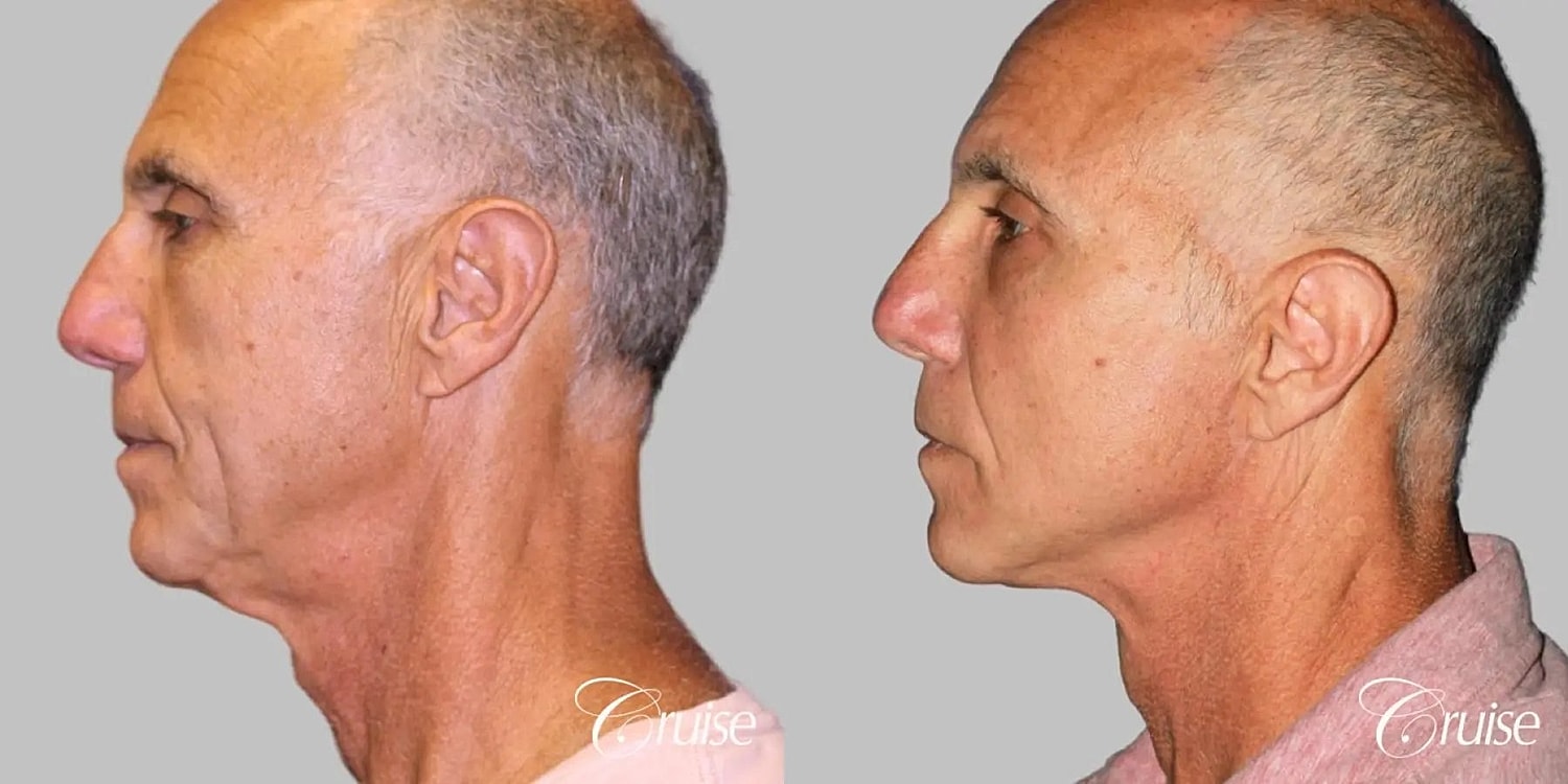 Neck Lift Before & After