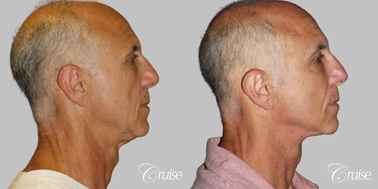 Neck Lift Before & After