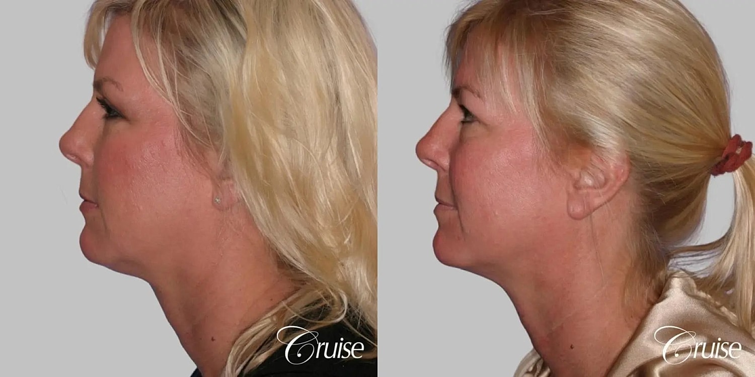 Neck Lift Before & After