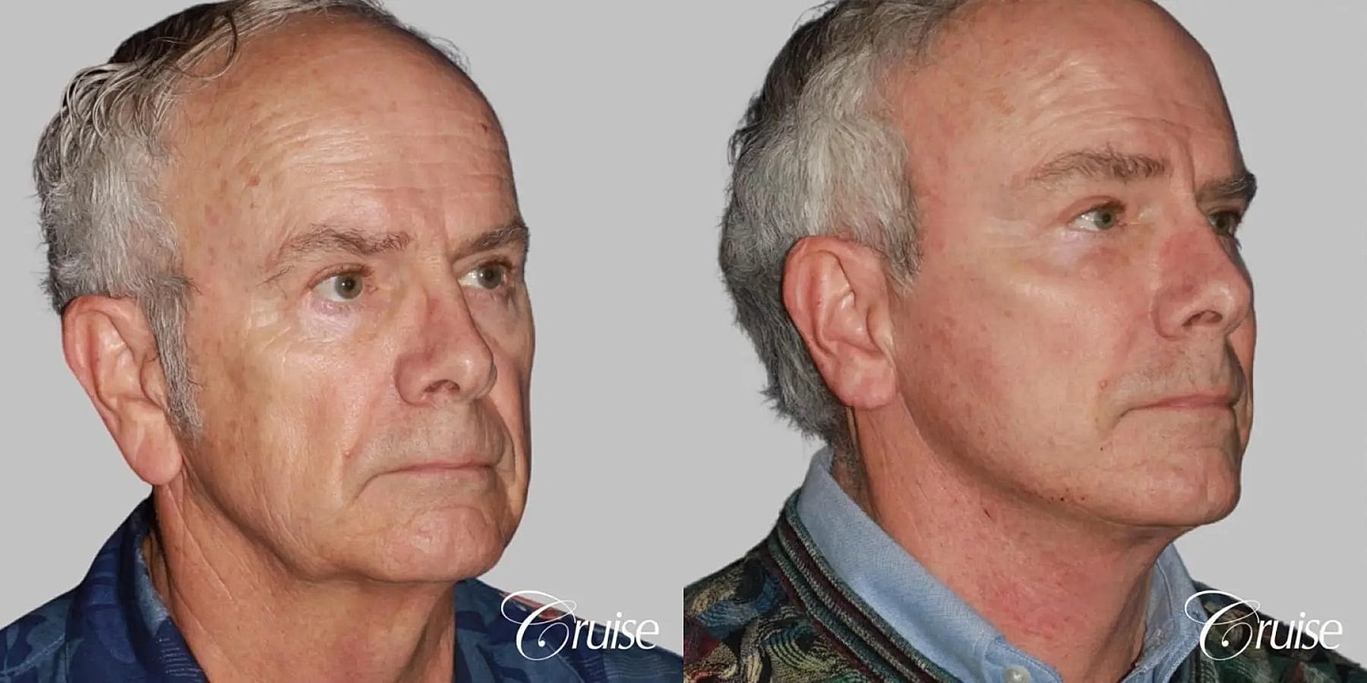 Neck Lift Before & After