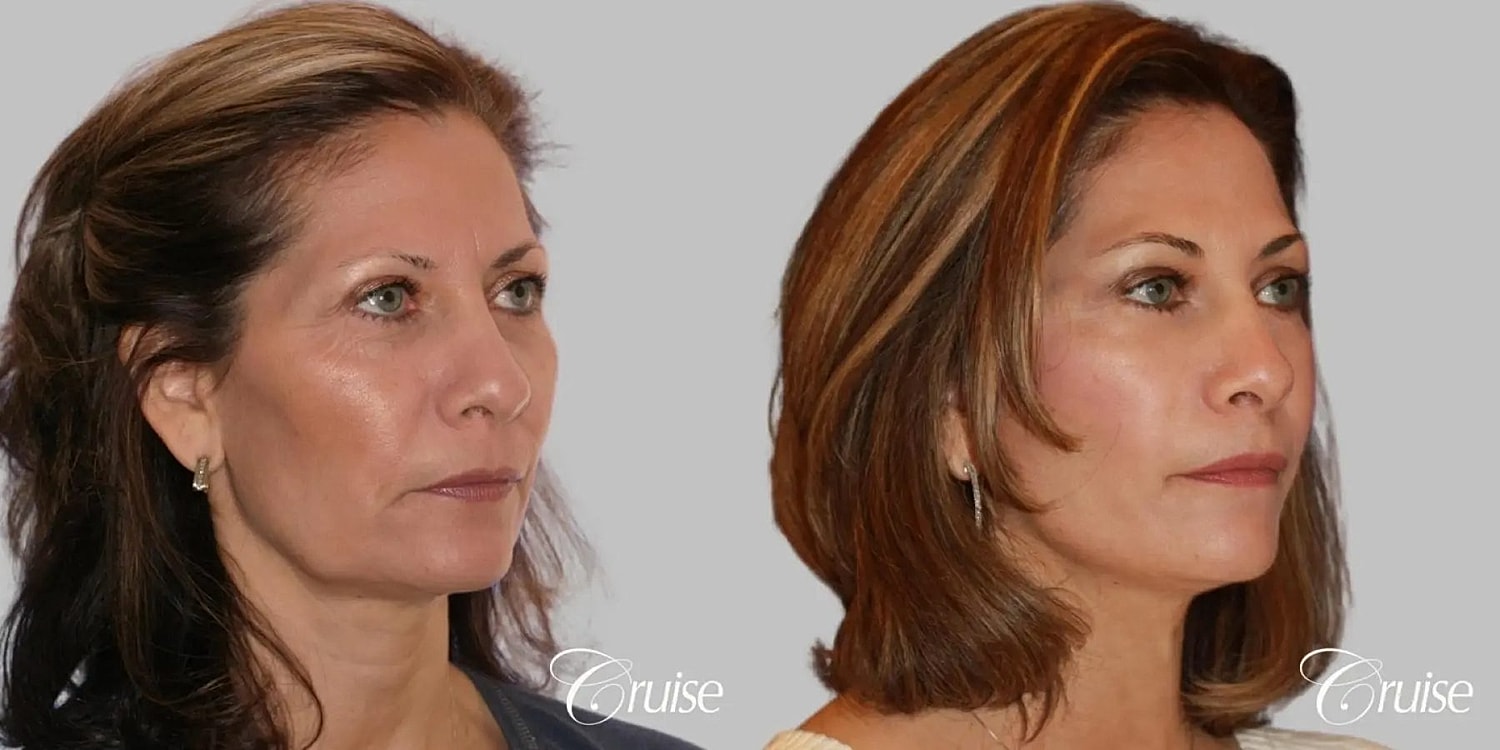 Neck Lift Before & After