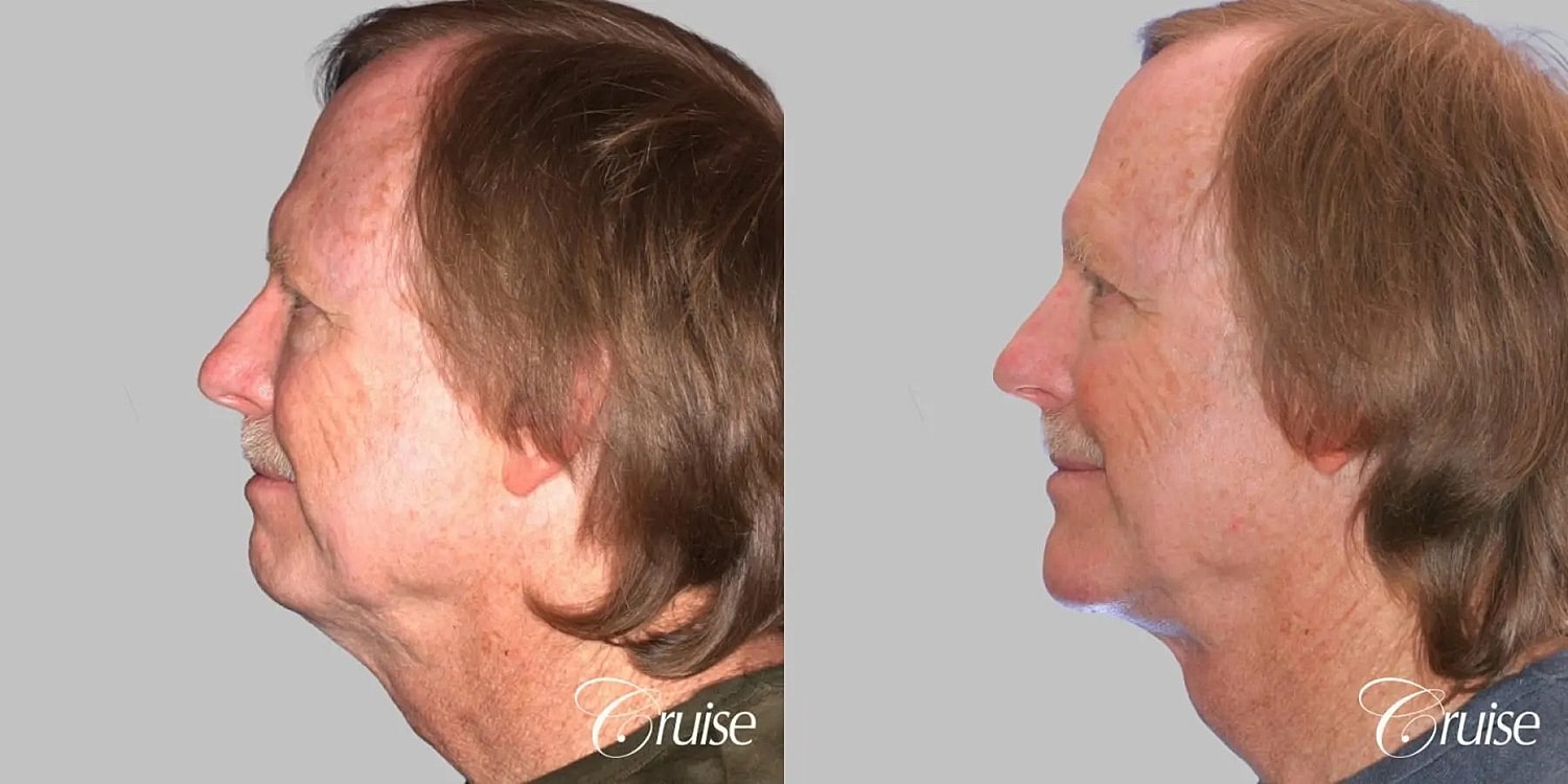 Neck Lift Before & After