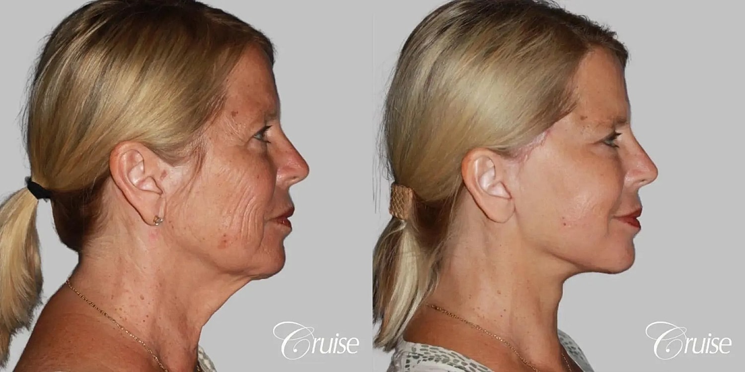 Neck Lift Before & After