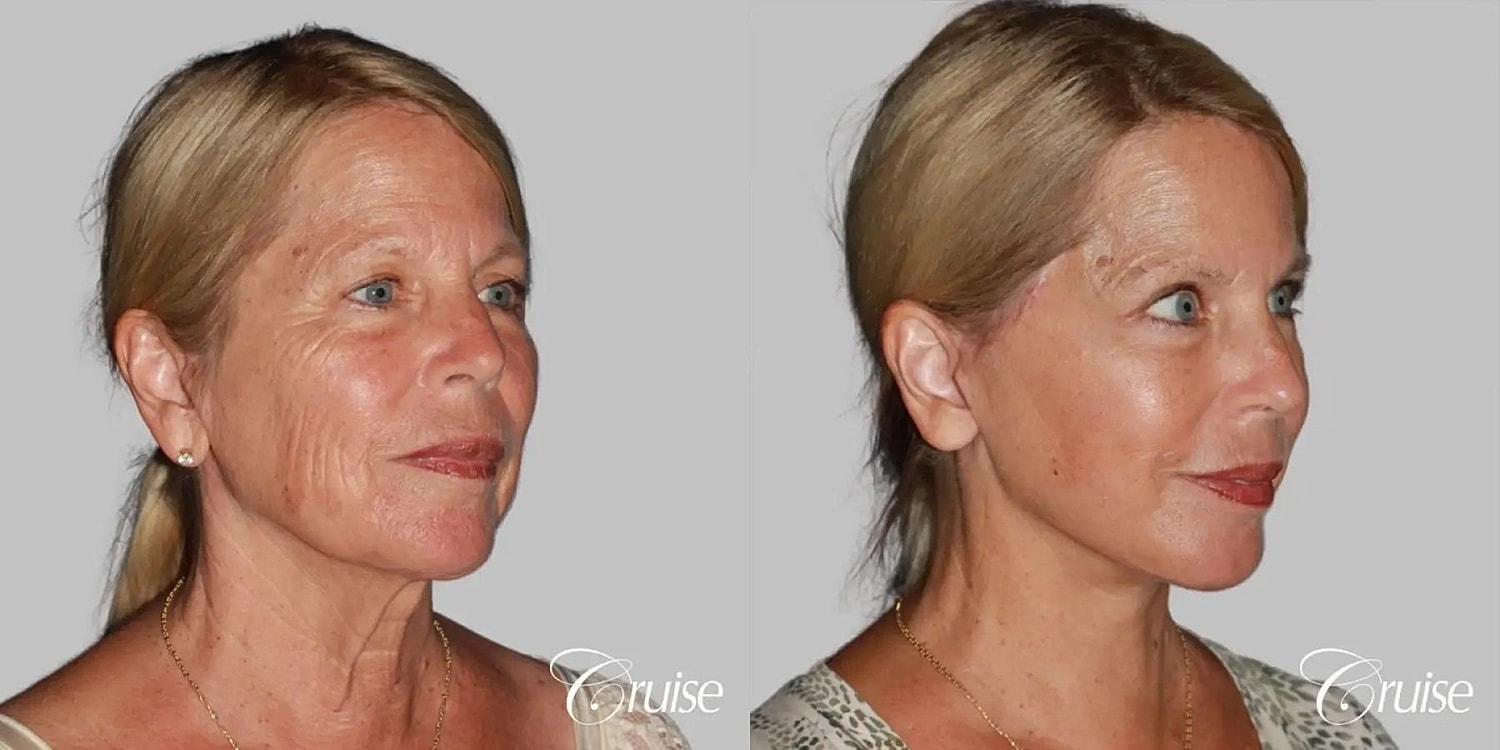 Neck Lift Before & After