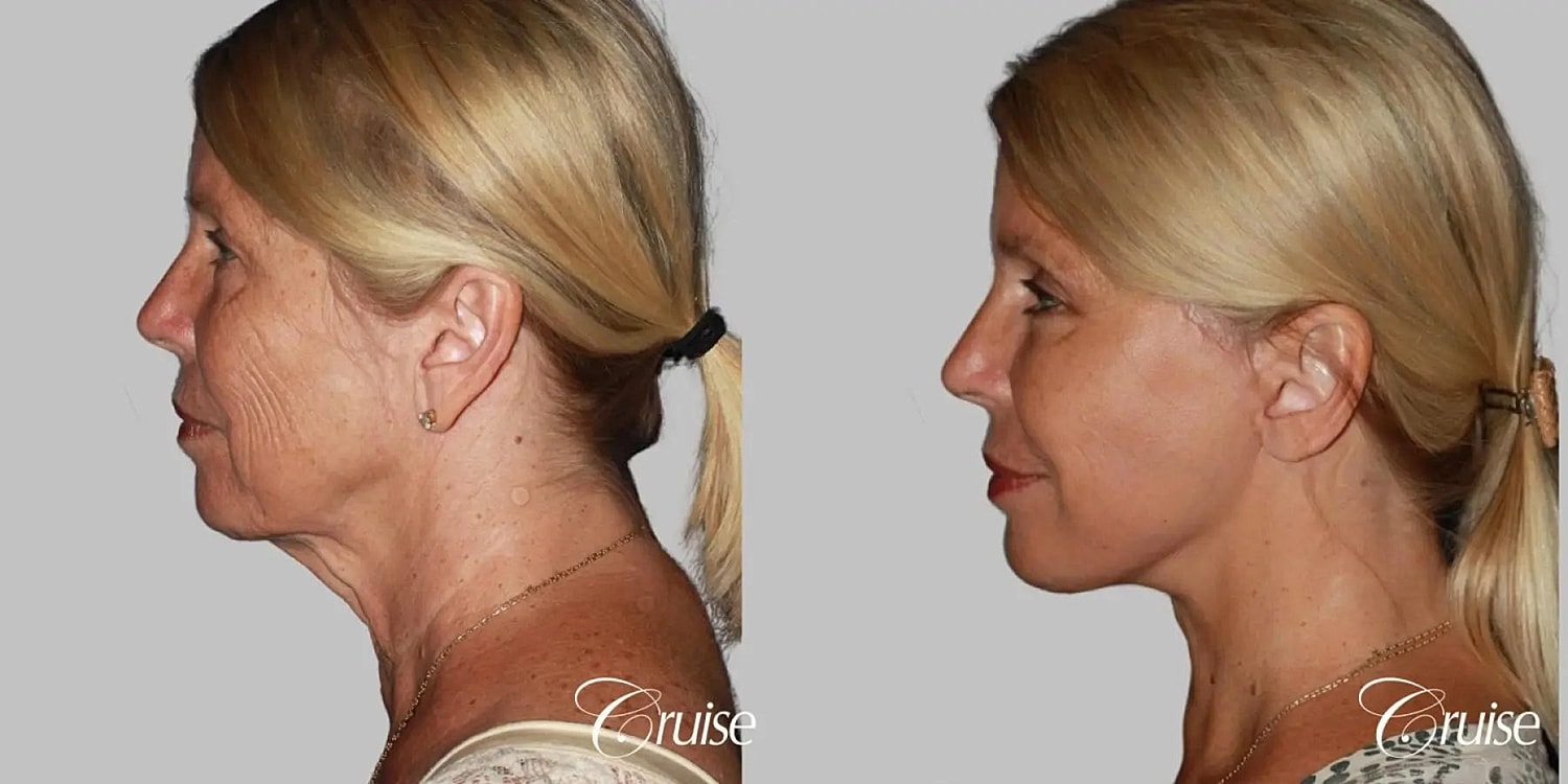 Neck Lift Before & After