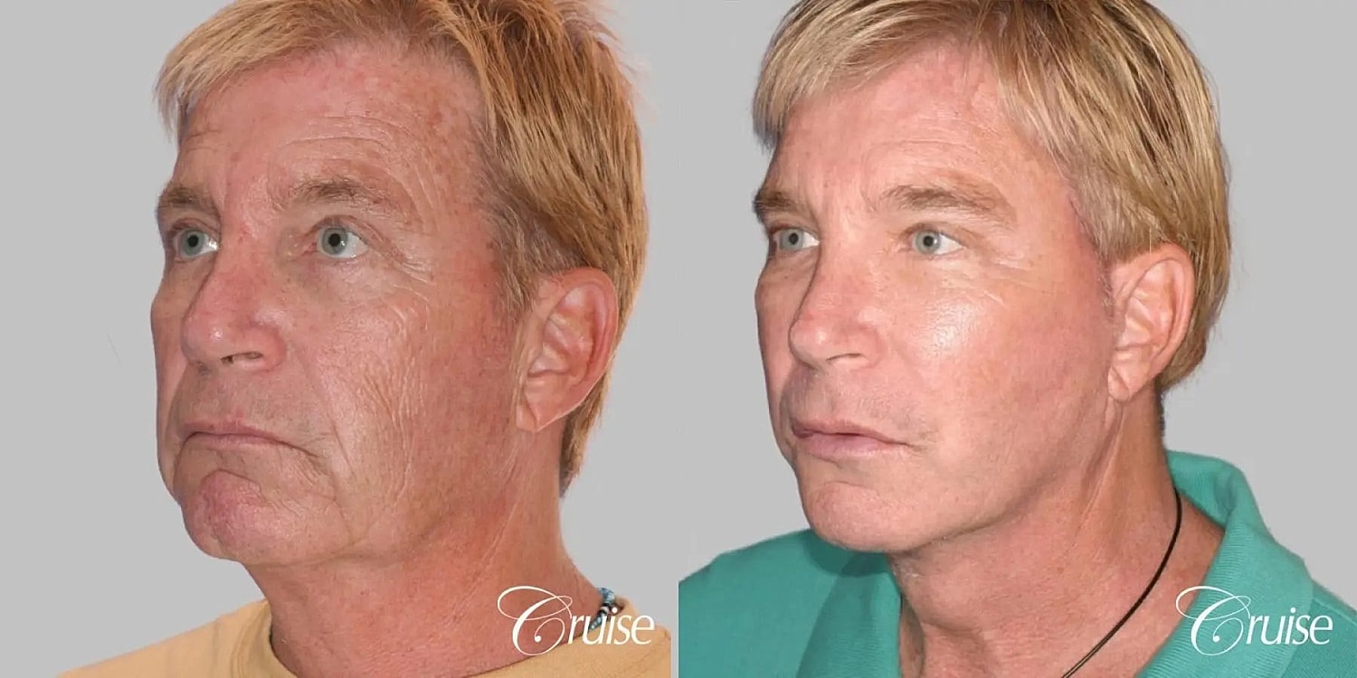 Neck Lift Before & After