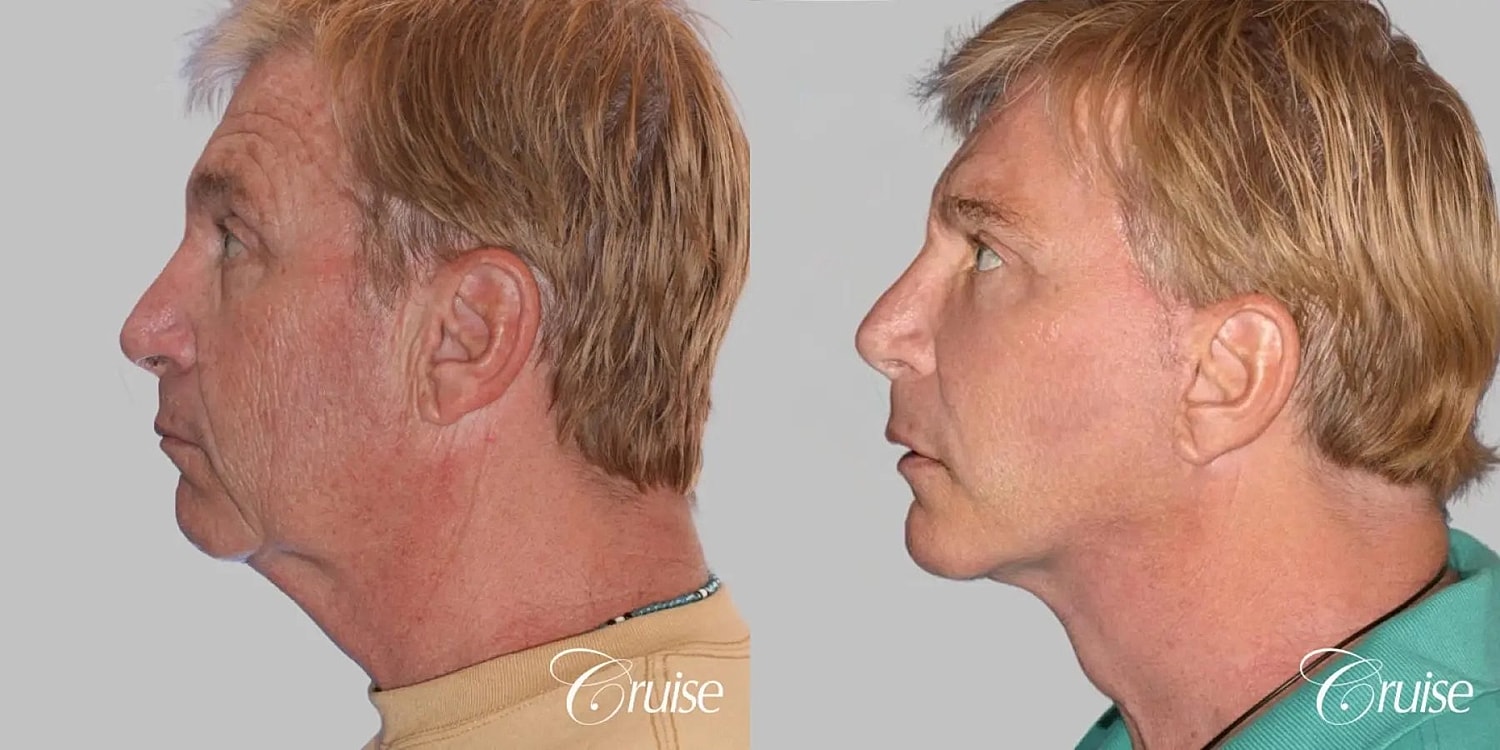 Neck Lift Before & After