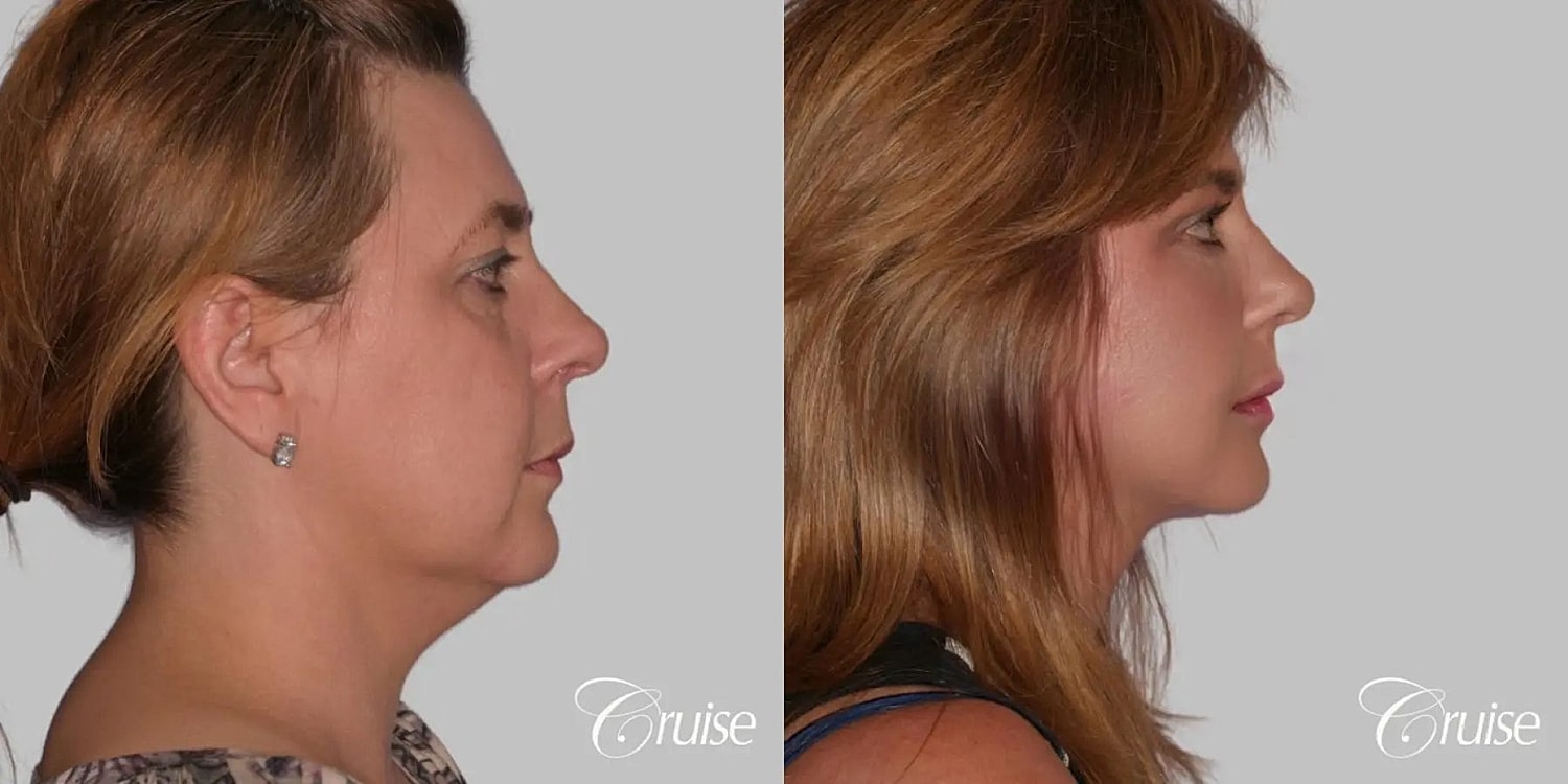 Neck Lift Before & After