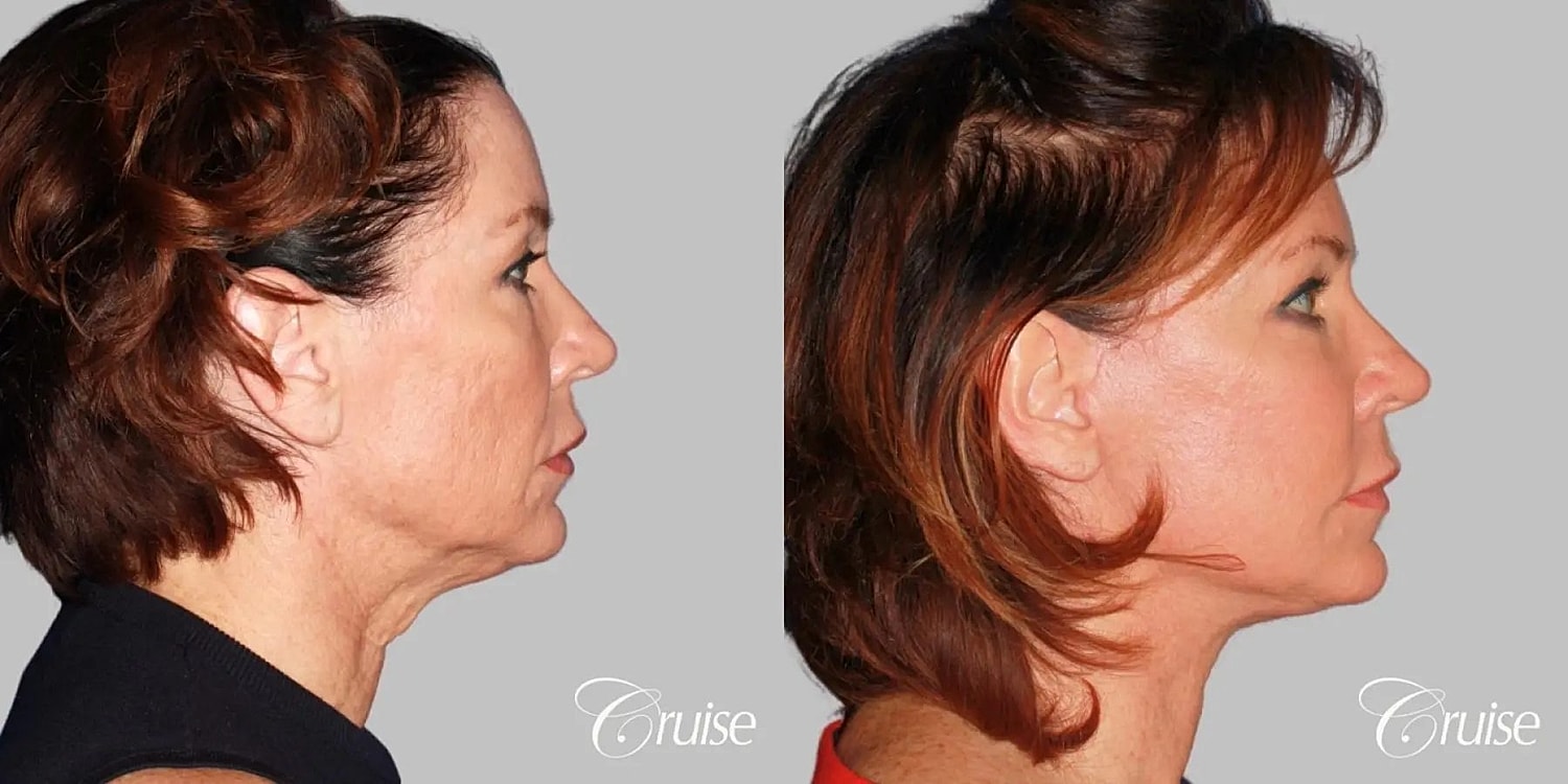 Neck Lift Before & After