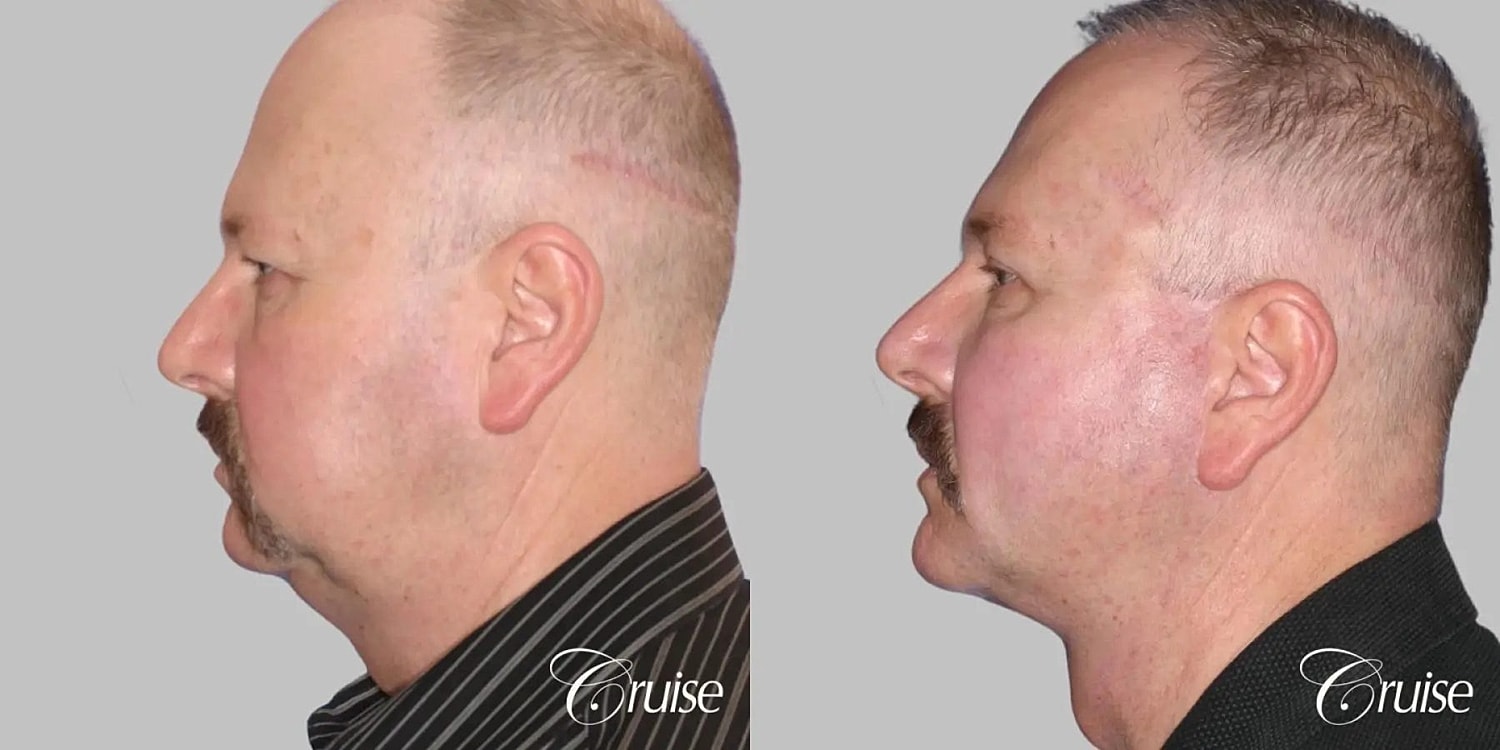 Neck Lift Before & After