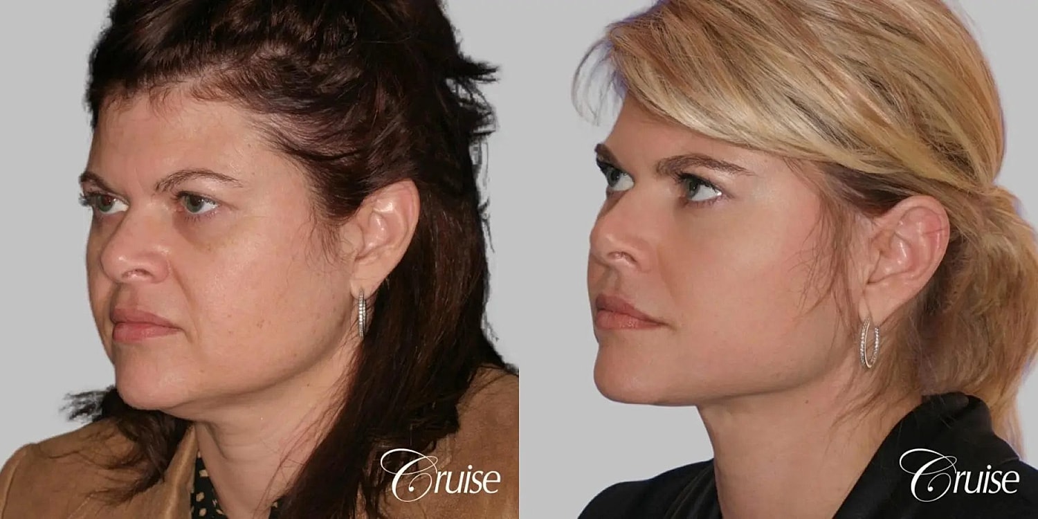 Neck Lift Before & After