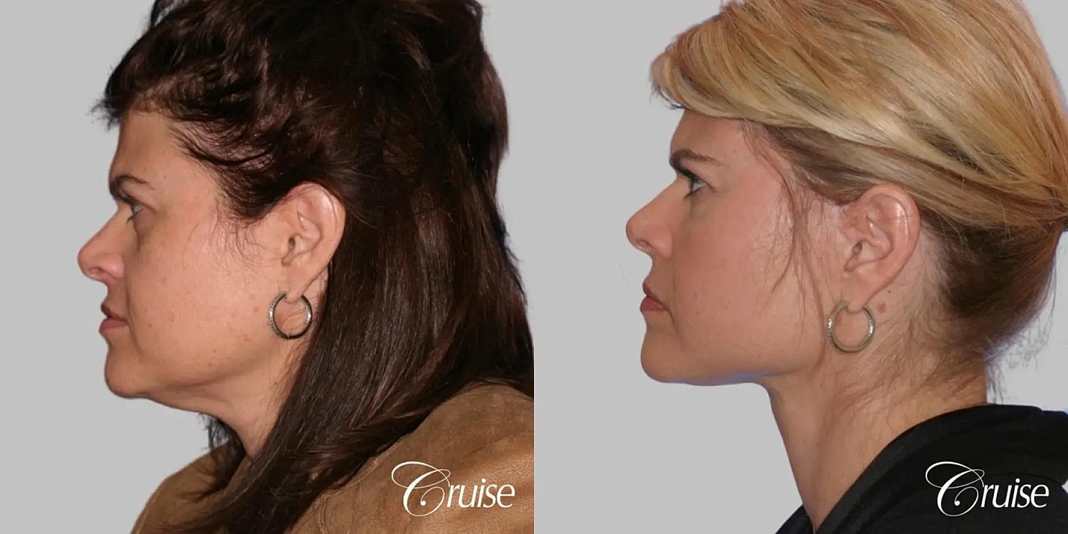 Neck Lift Before & After