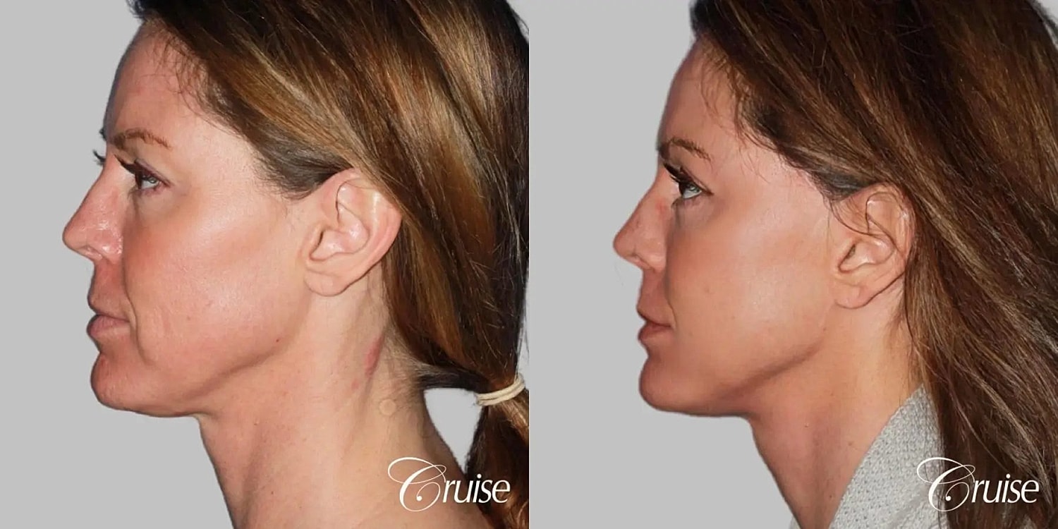 Neck Lift Before & After