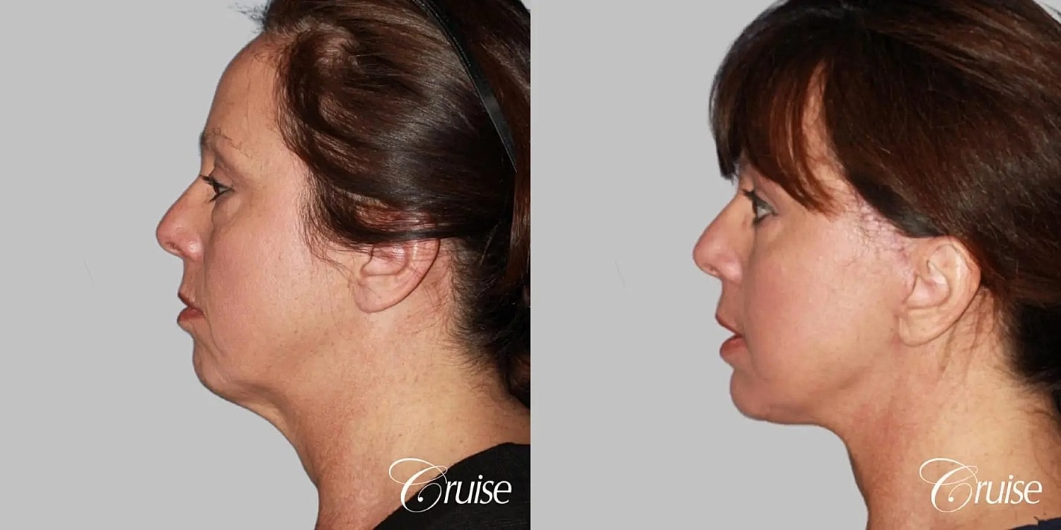 Neck Lift Before & After