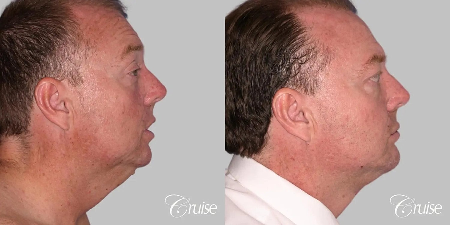 Neck Lift Before & After