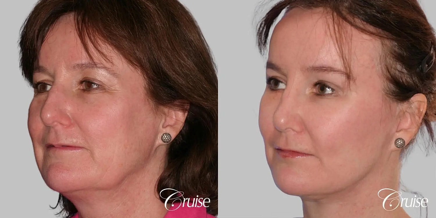 Neck Lift Before & After