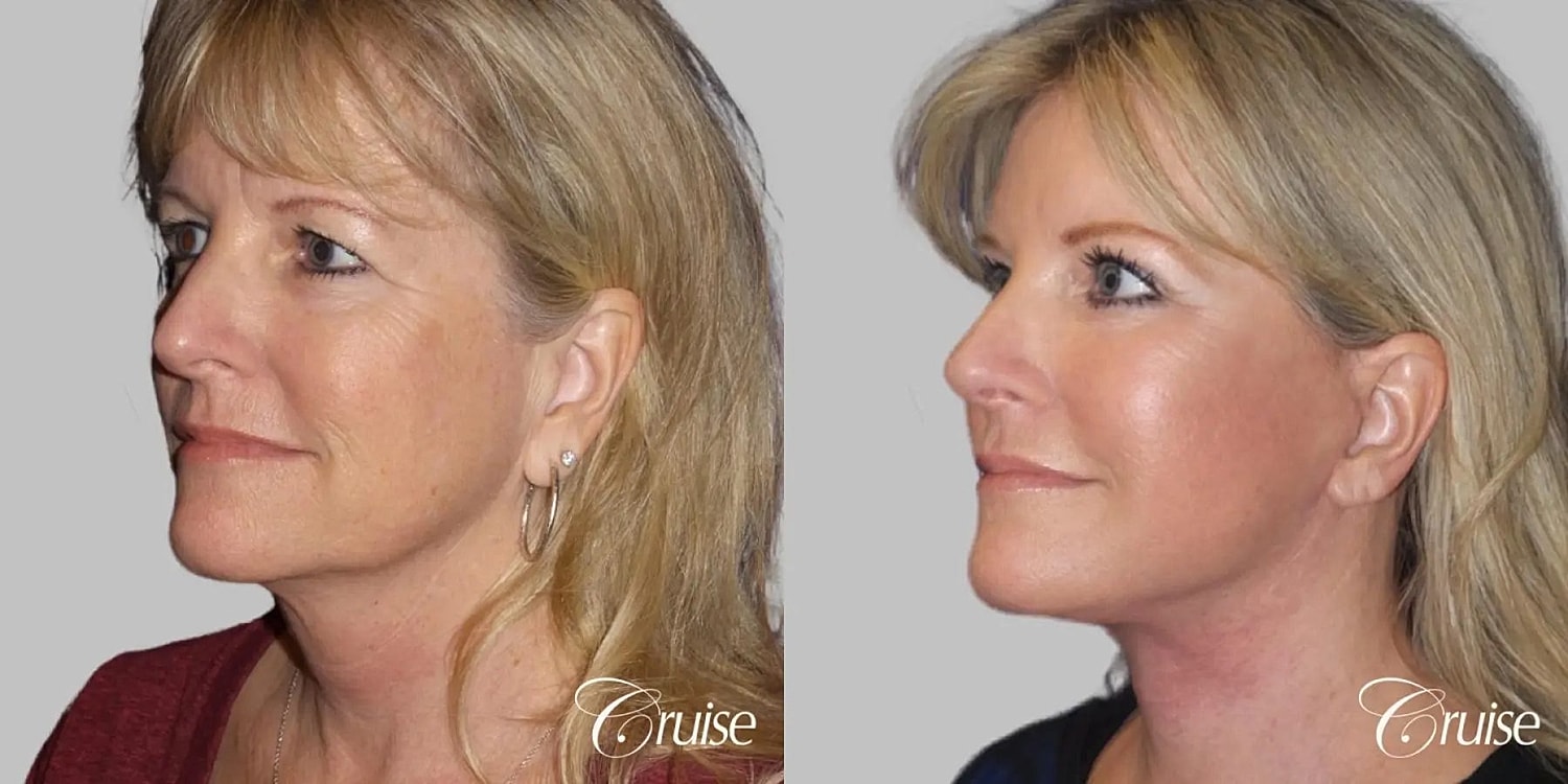 Neck Lift Before & After