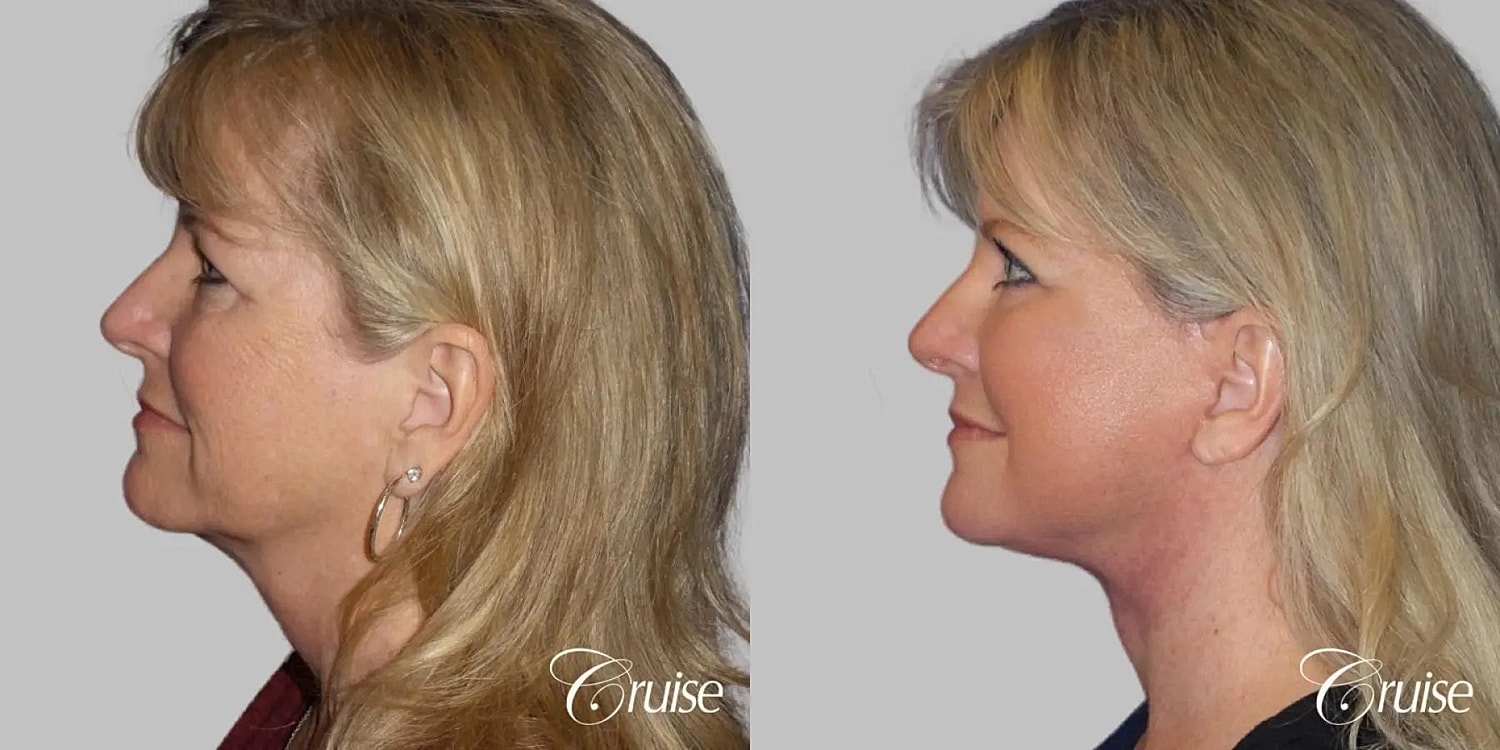 Neck Lift Before & After