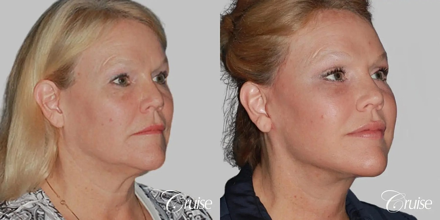 Neck Lift Before & After