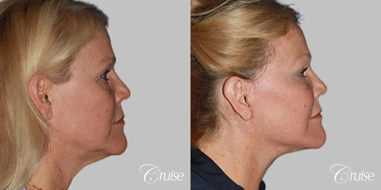 Neck Lift Before & After