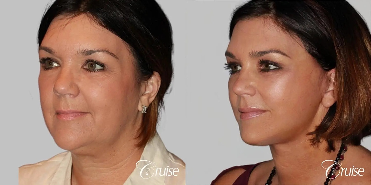 Neck Lift Before & After