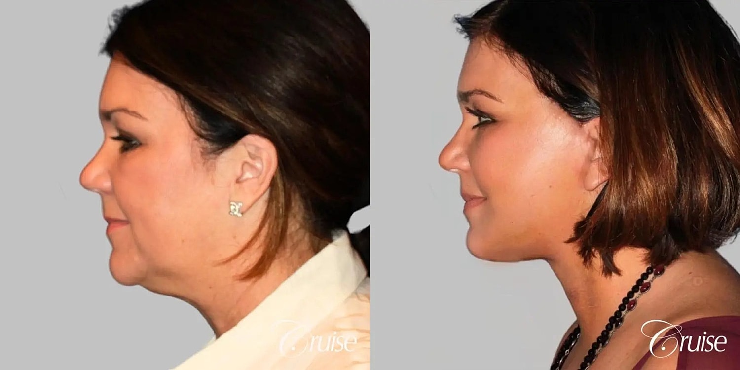 Neck Lift Before & After