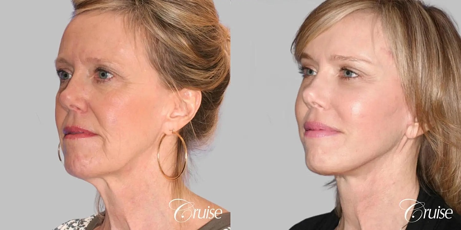 Neck Lift Before & After