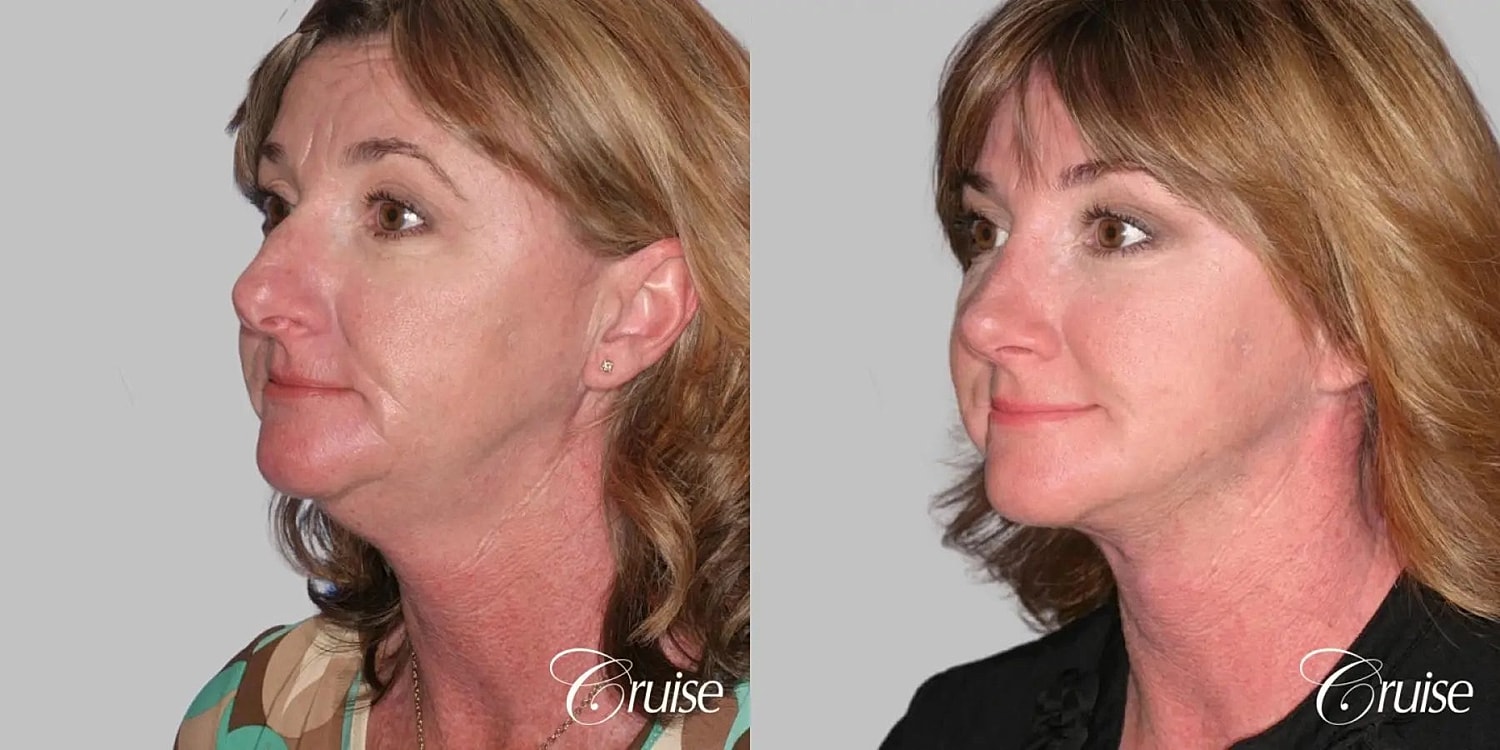 Neck Lift Before & After