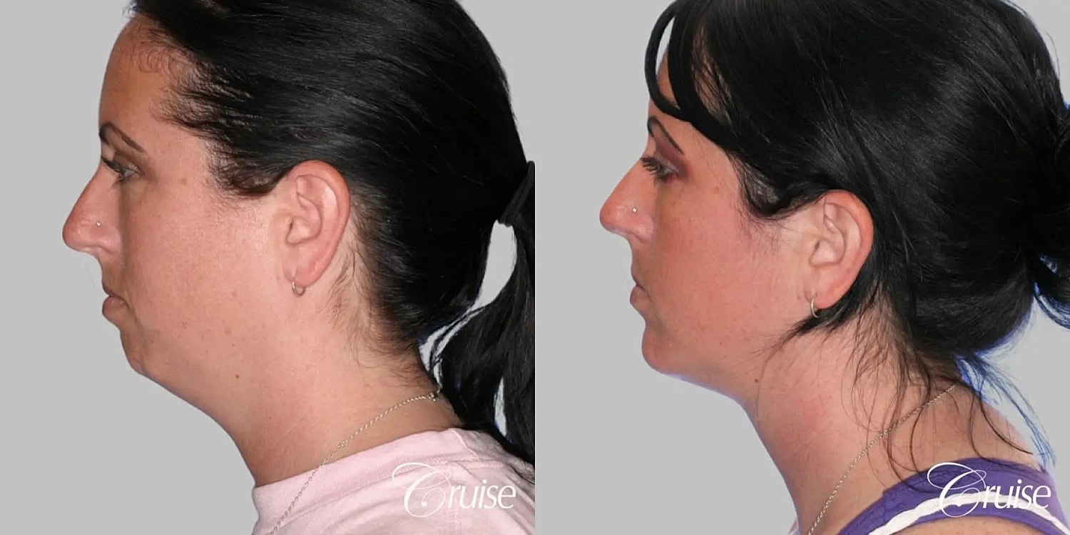 Neck Lift Before & After