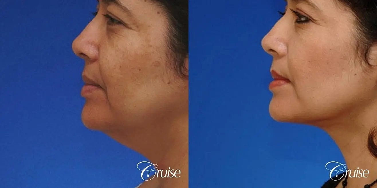 Neck Lift Before & After