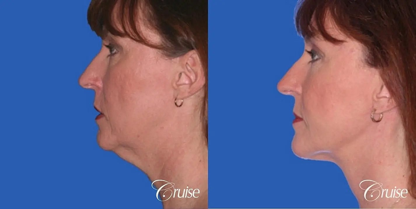 Neck Lift Before & After