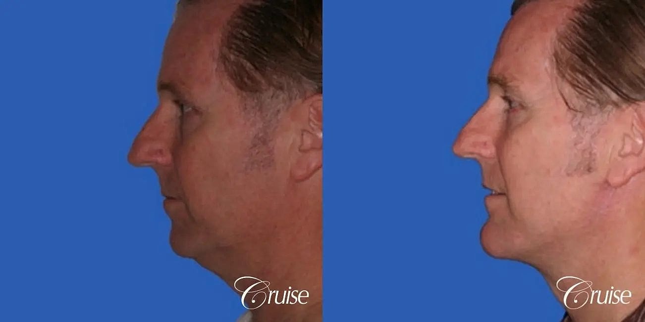 Neck Lift Before & After