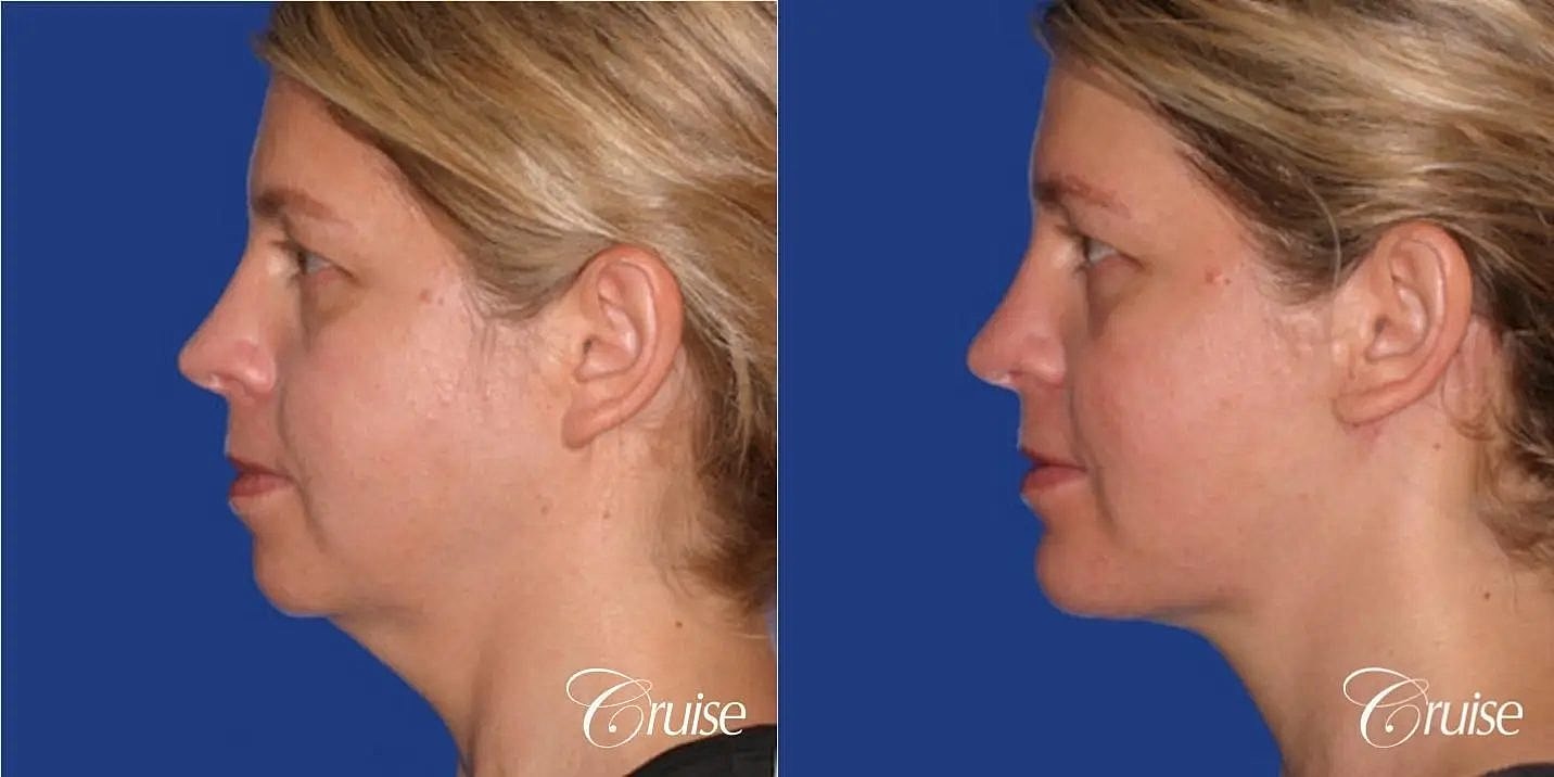 Neck Lift Before & After
