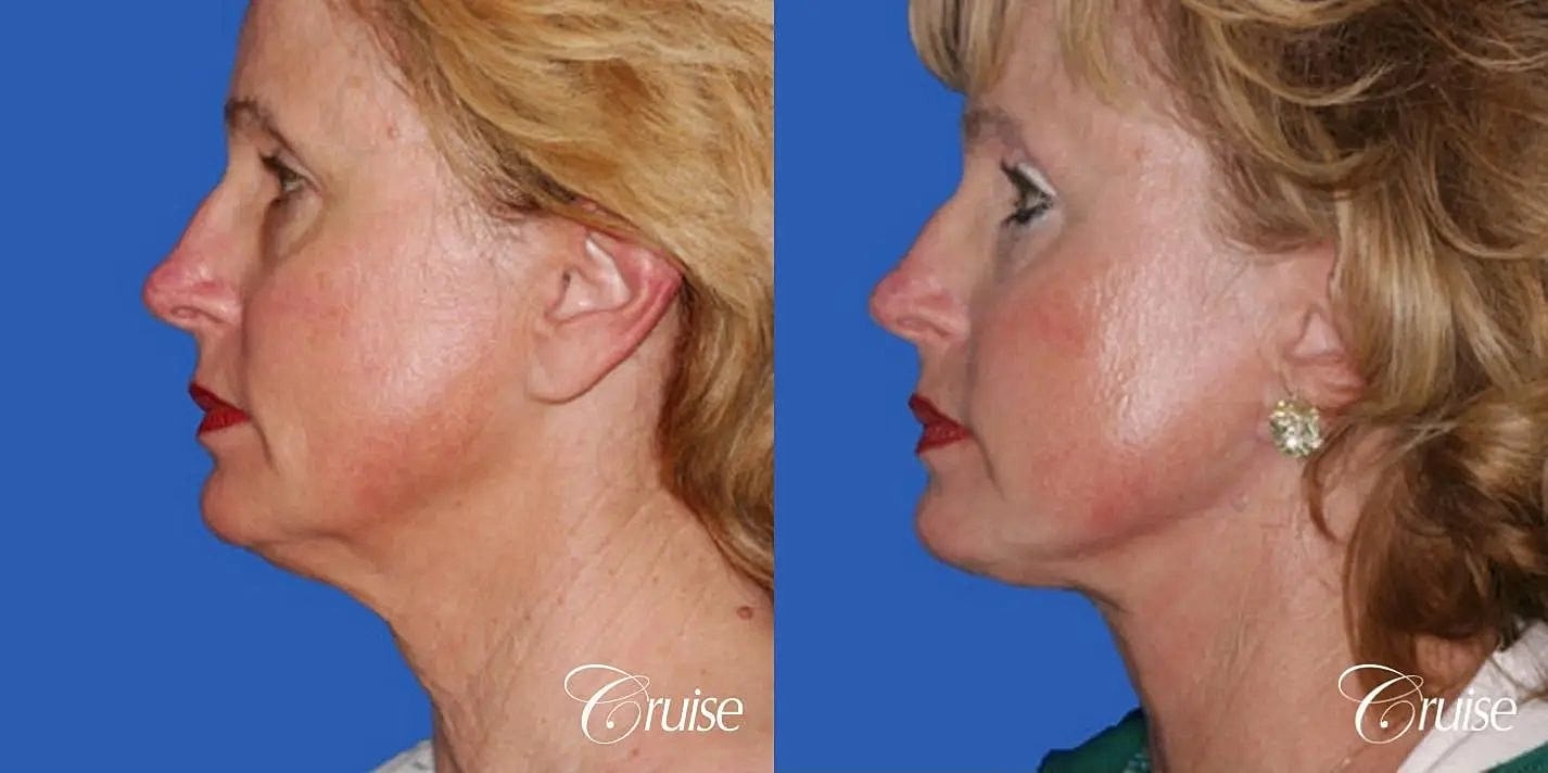 Neck Lift Before & After