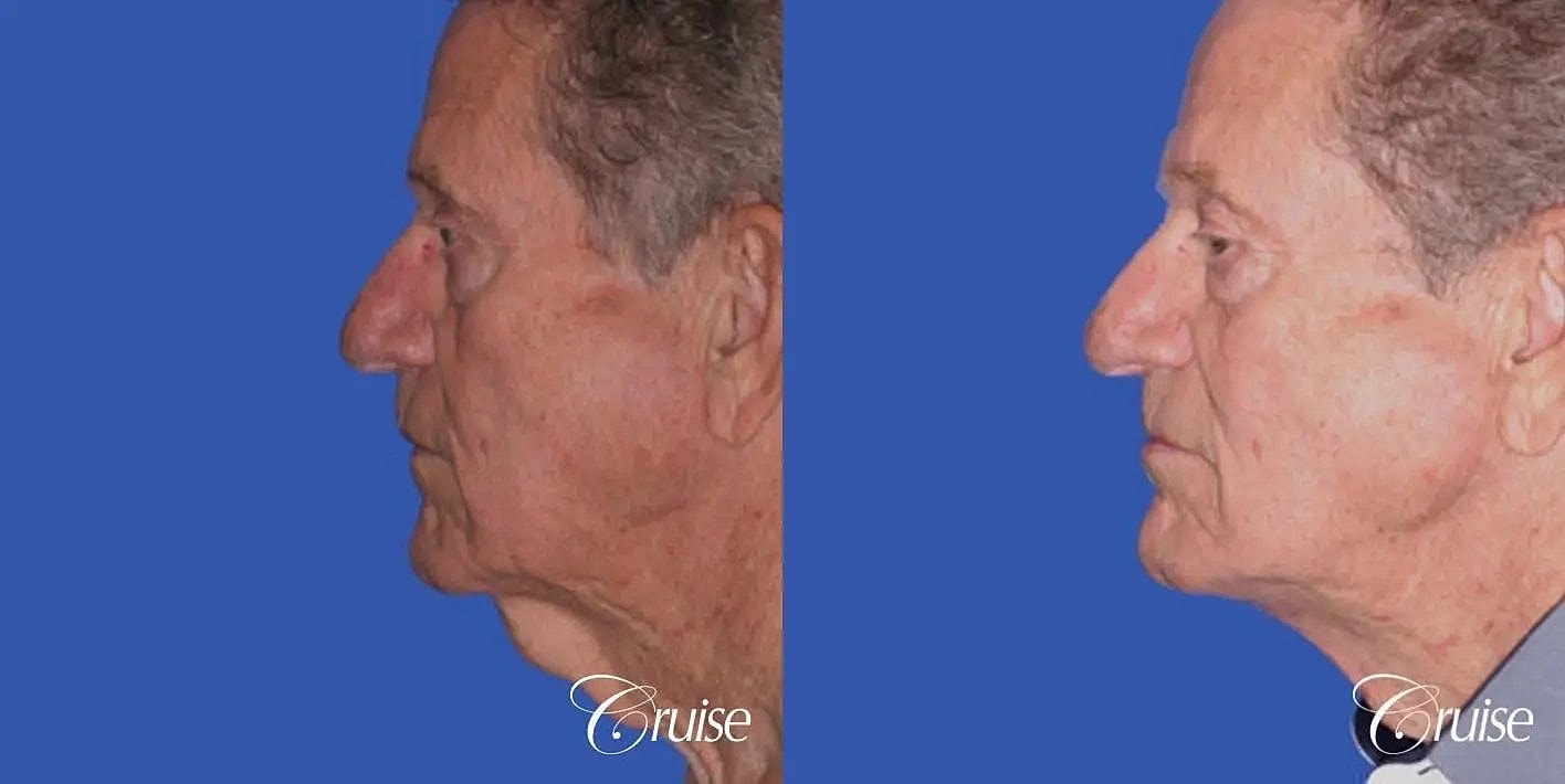 Neck Lift Before & After