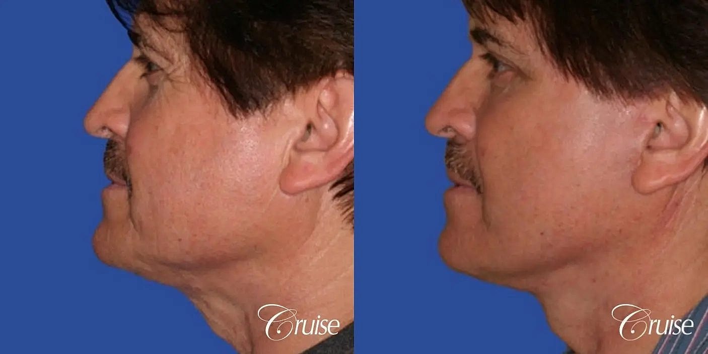 Neck Lift Before & After