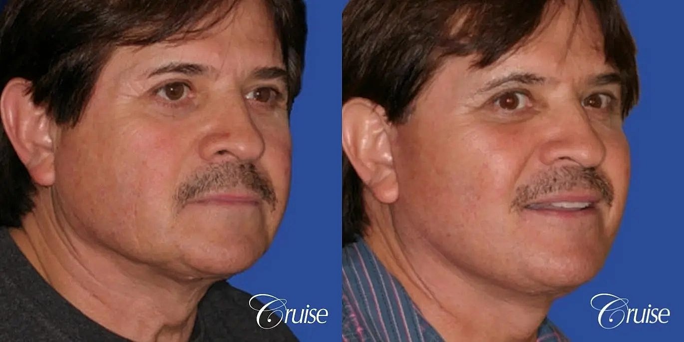 Neck Lift Before & After