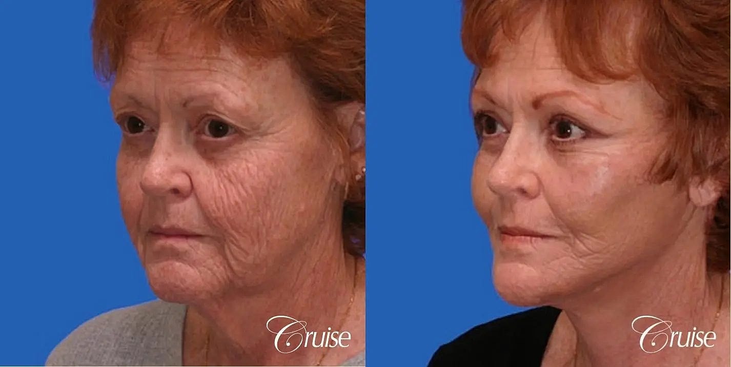 Neck Lift Before & After