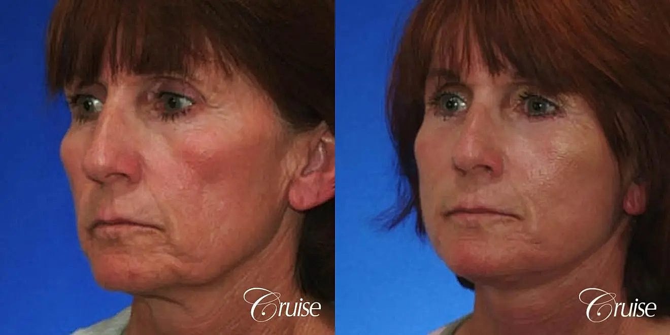 Neck Lift Before & After