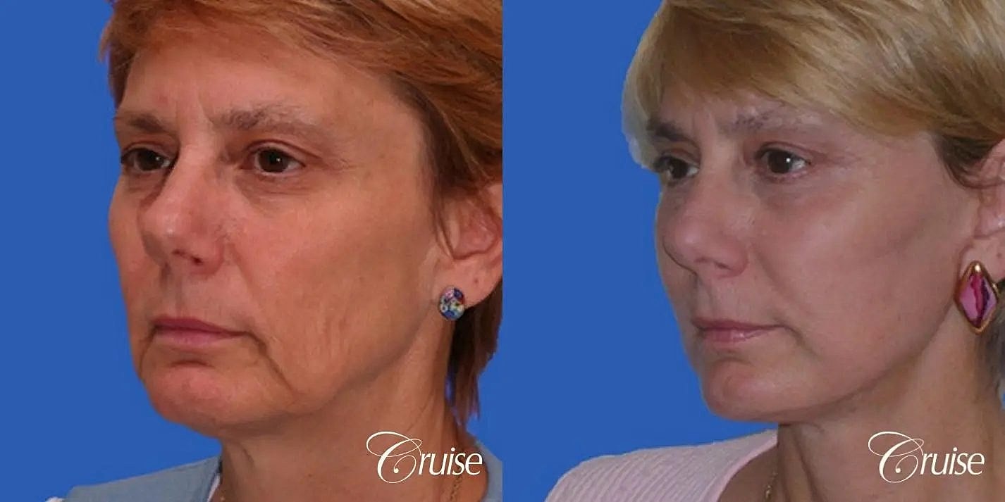 Neck Lift Before & After
