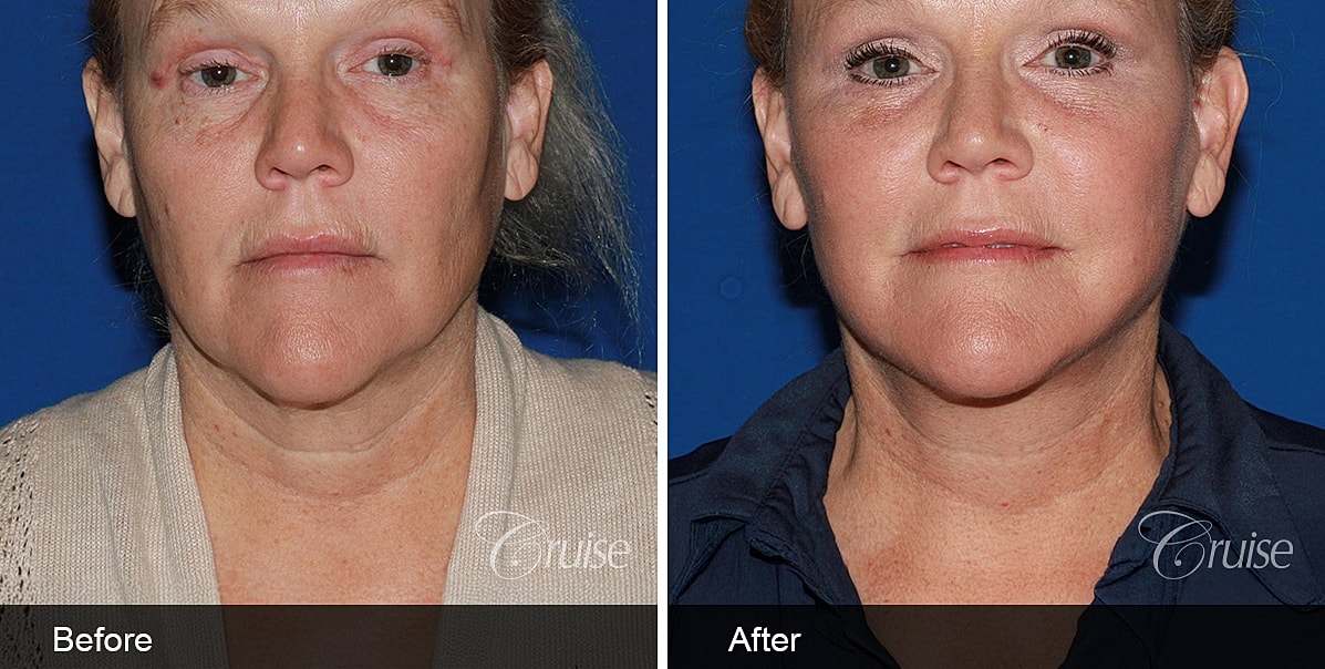 Neck Lift Before & After