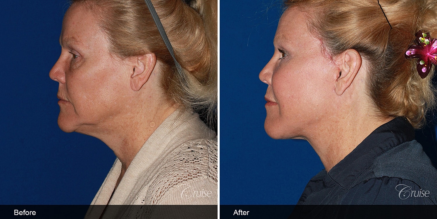 Neck Lift Before & After