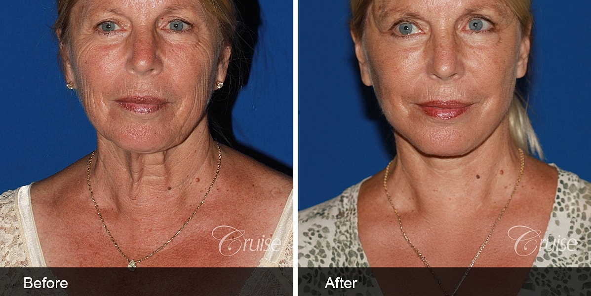 Neck Lift Before & After
