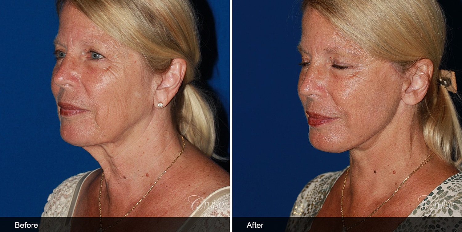 Neck Lift Before & After