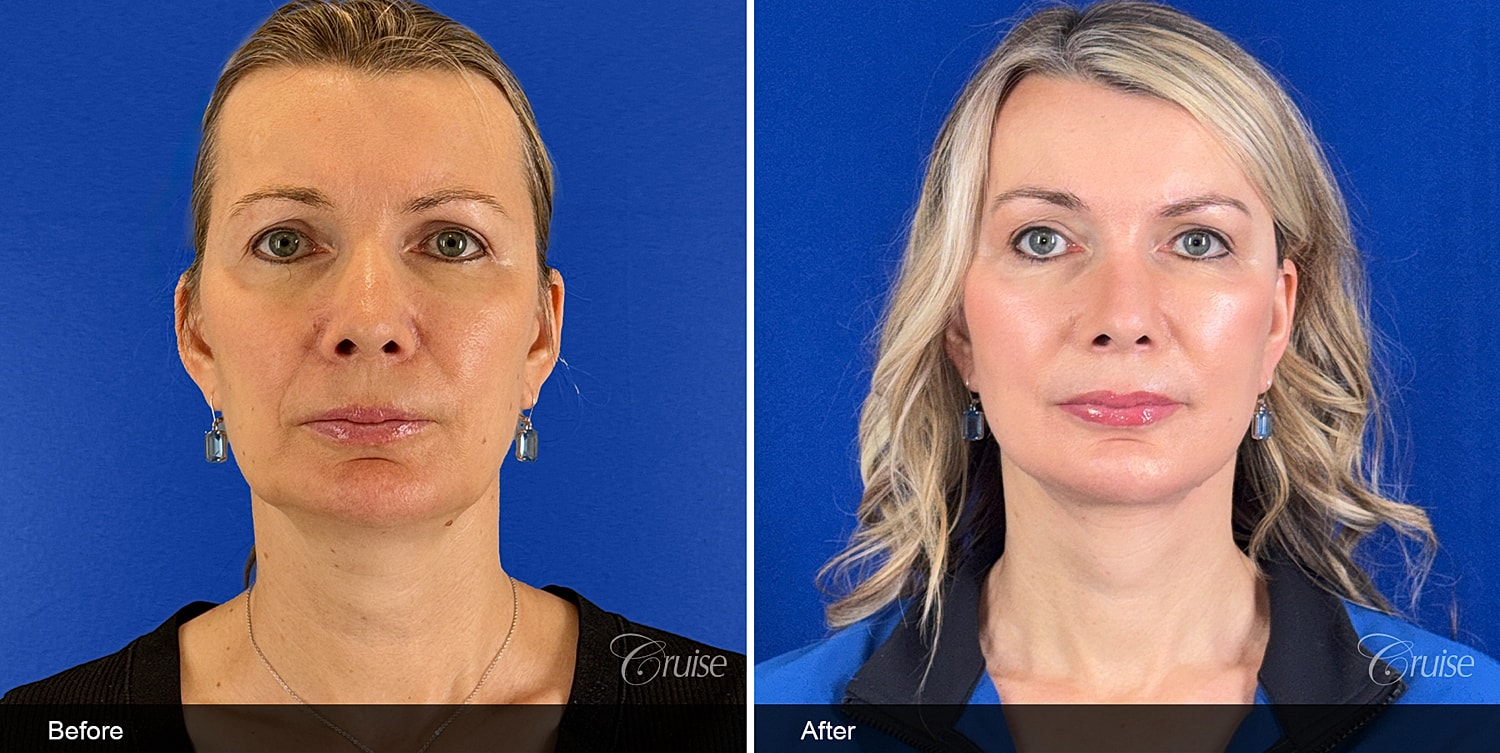 Neck Lift Before & After