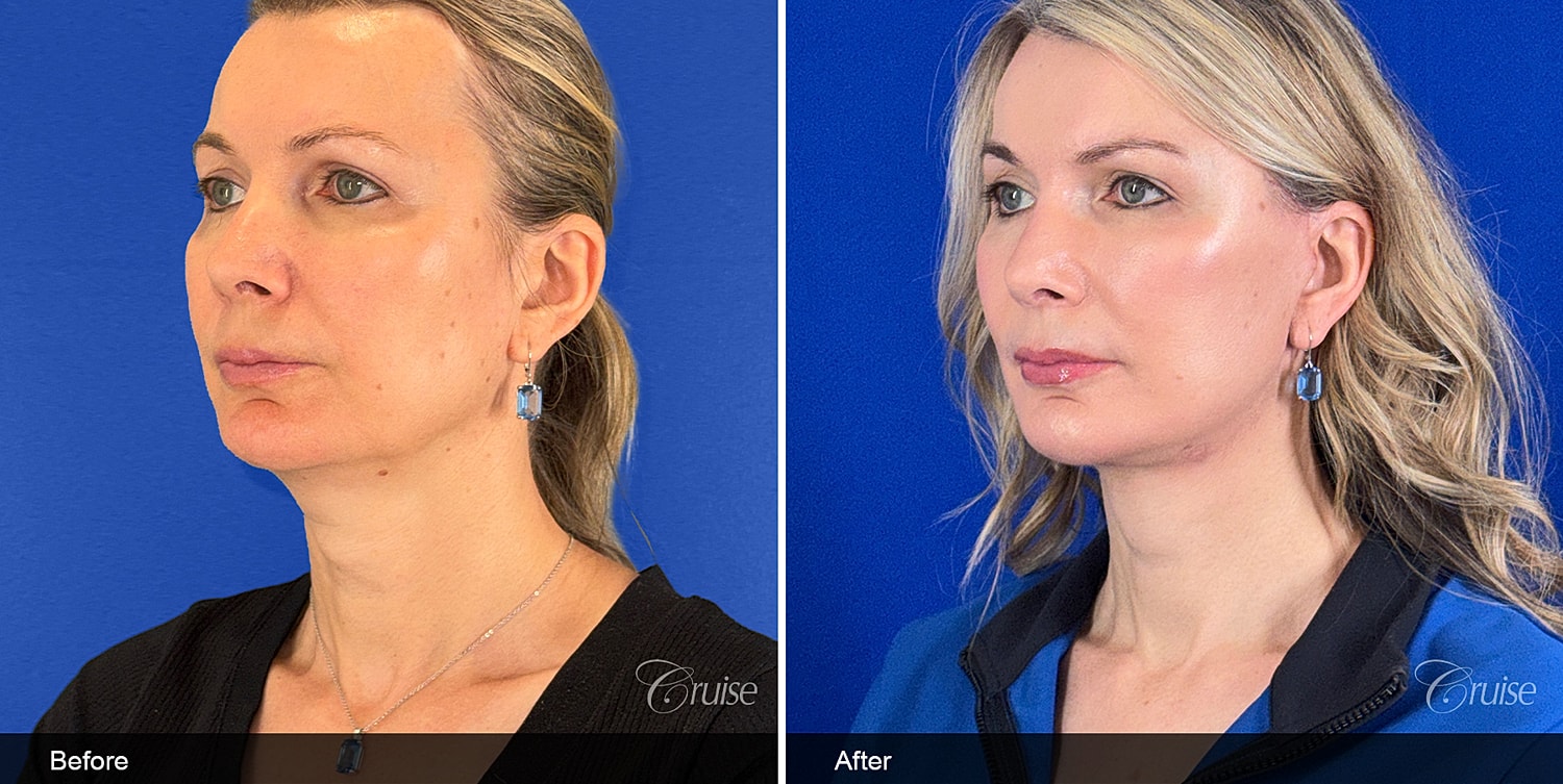 Neck Lift Before & After