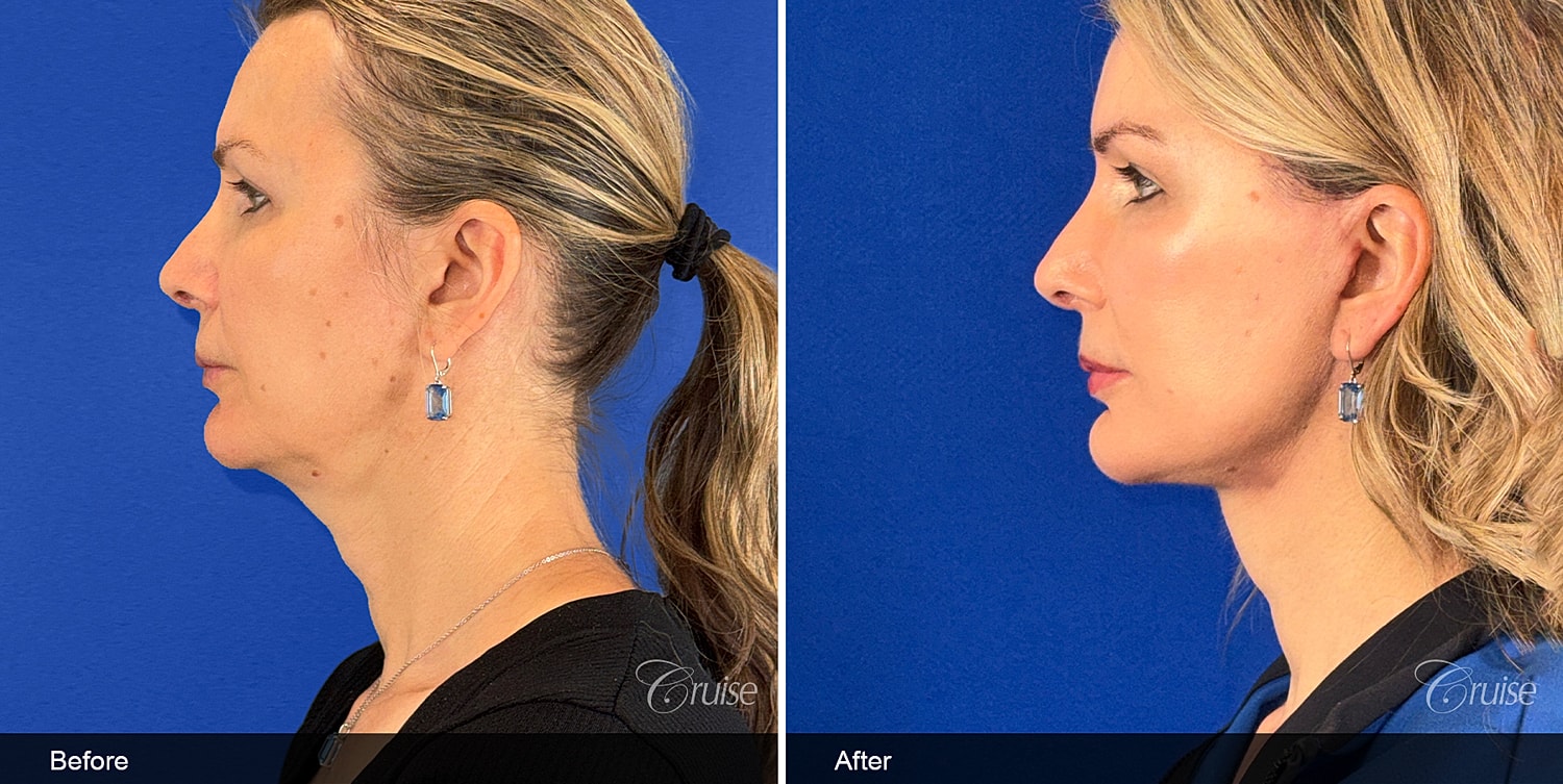 Neck Lift Before & After