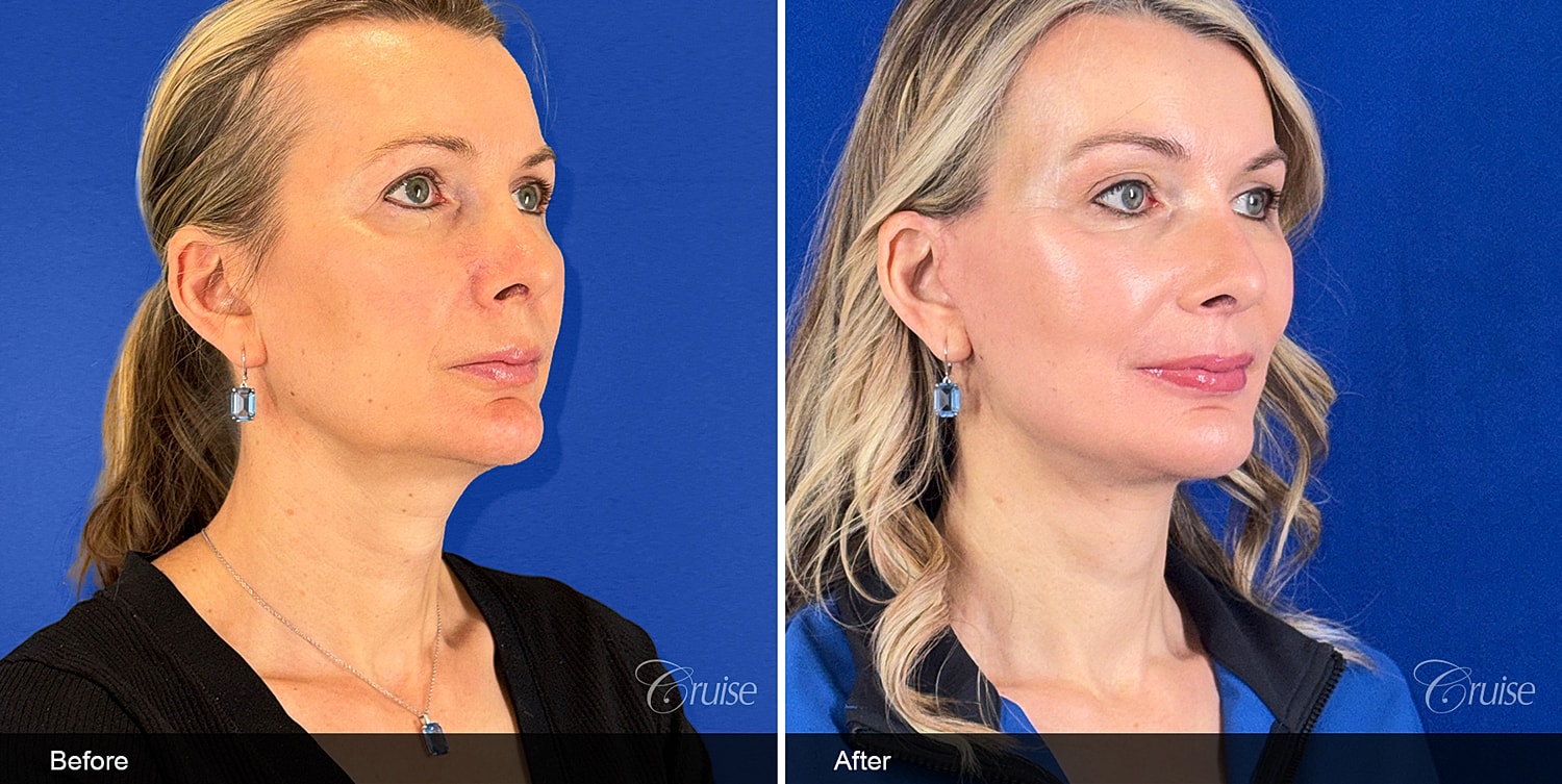 Neck Lift Before & After