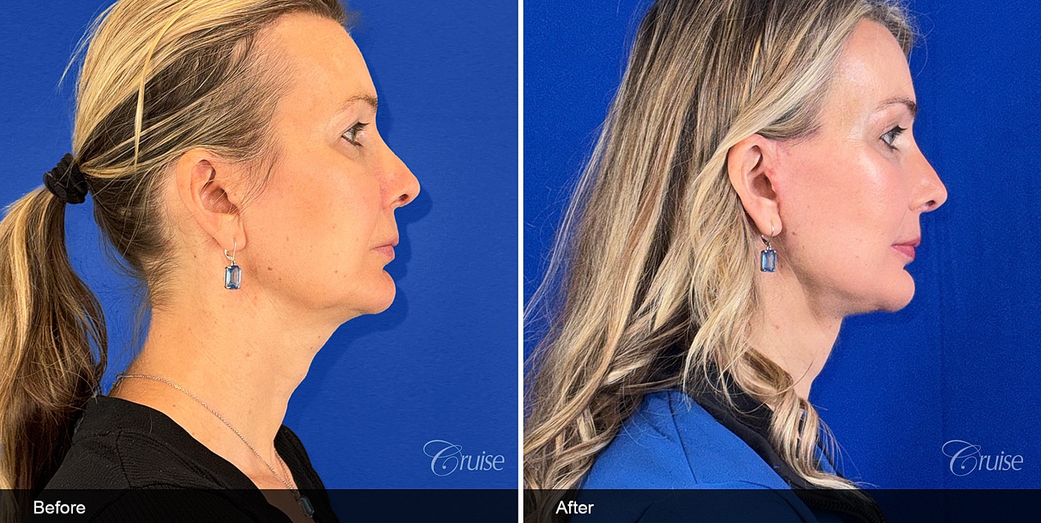 Neck Lift Before & After