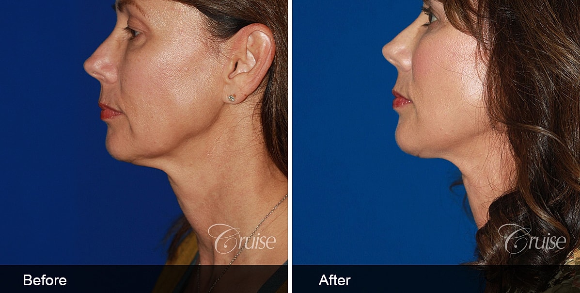Neck Lift Before & After